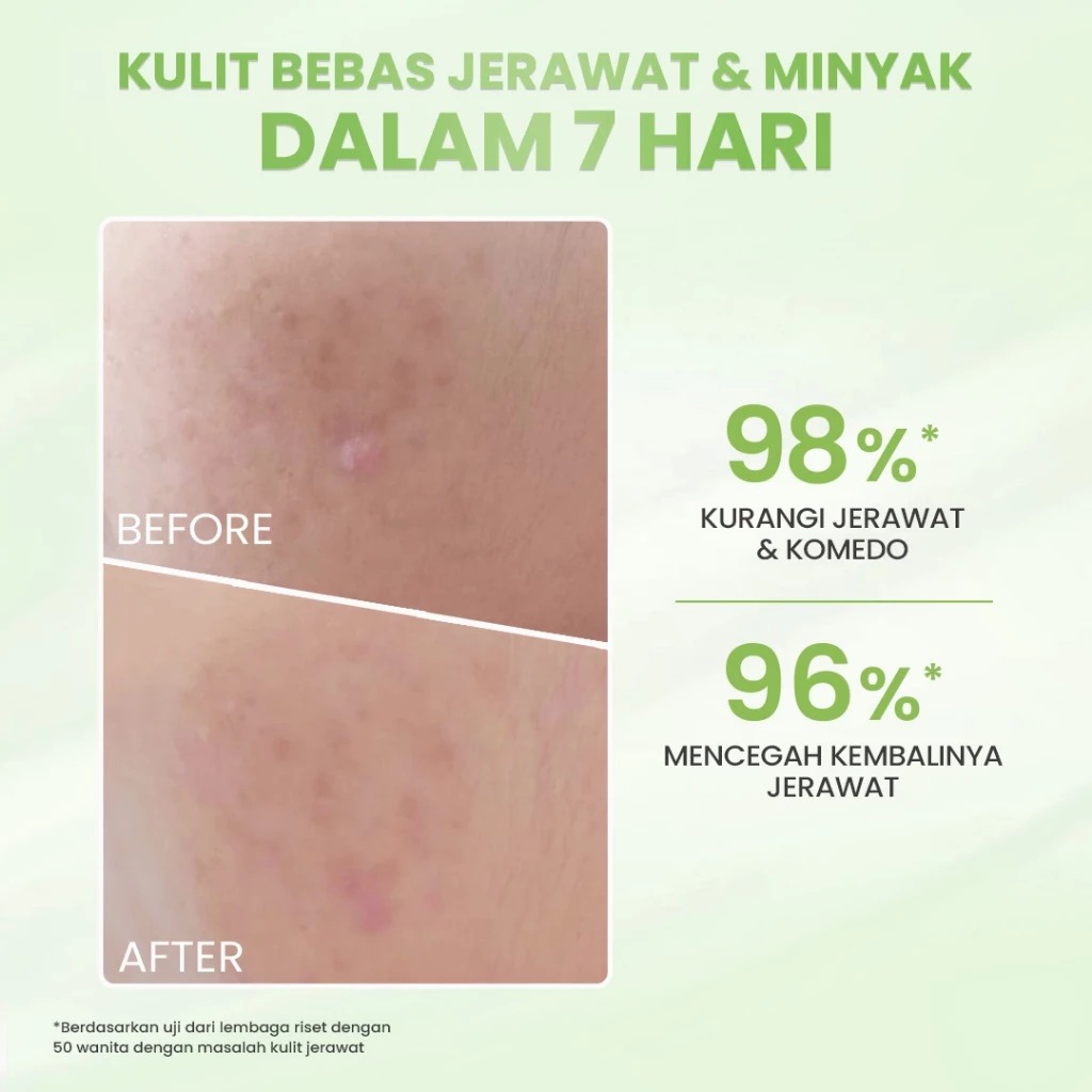 HANASUI Acne Expert 10X Calming & Oil Balancing Essence 105ml