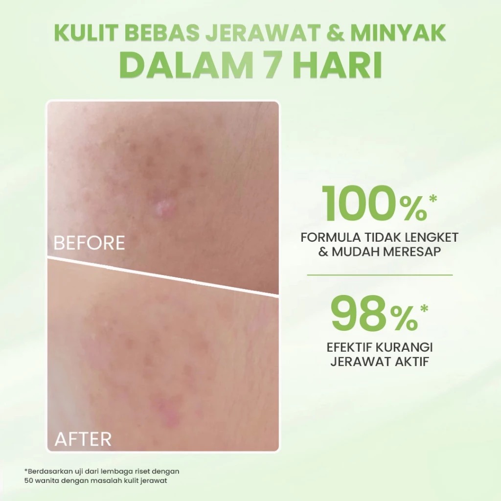 Hanasui Acne Expert Spot Gel 10X Calming & Oil Balancing Essence 15gr