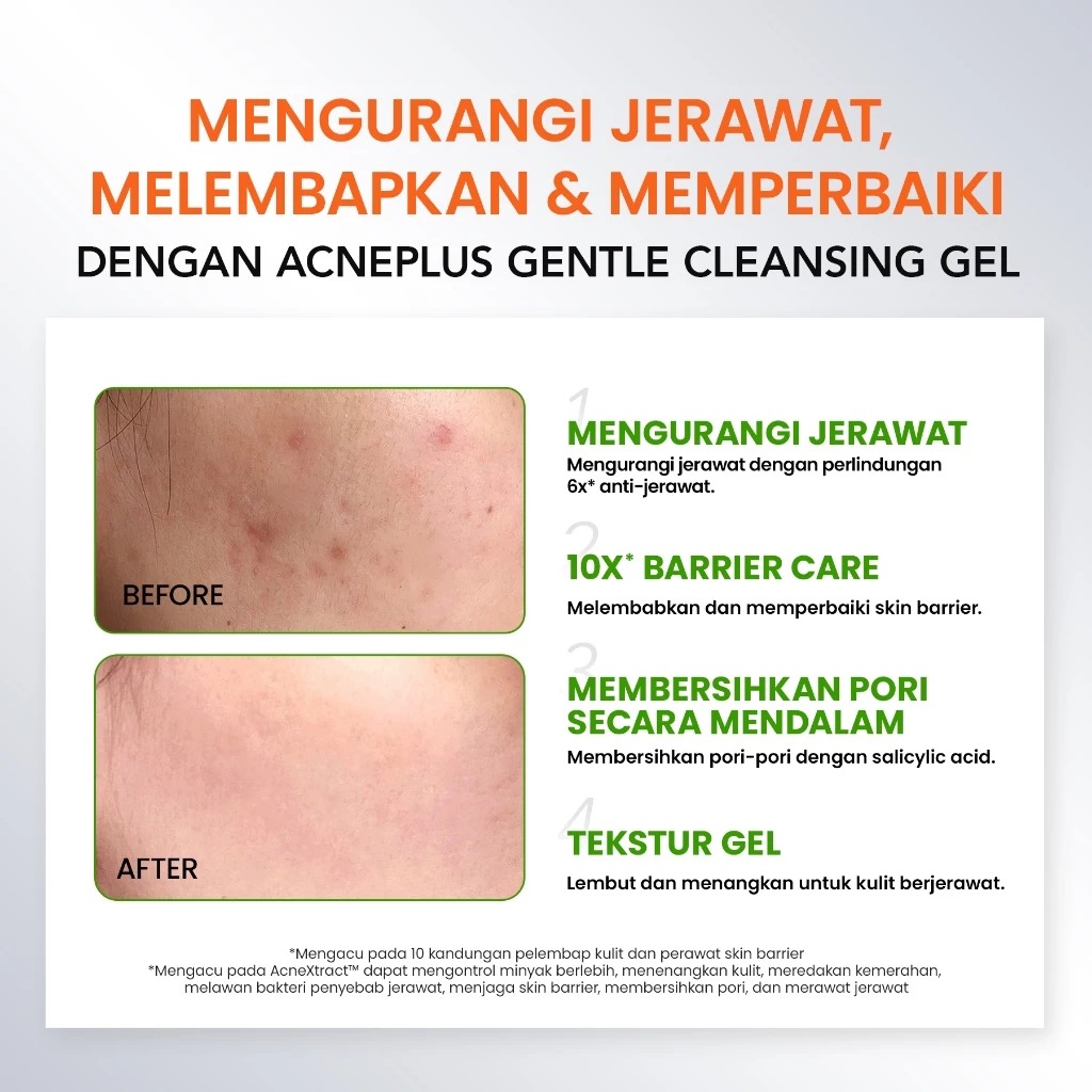YOU Acneplus Gentle Cleansing Gel 100gr