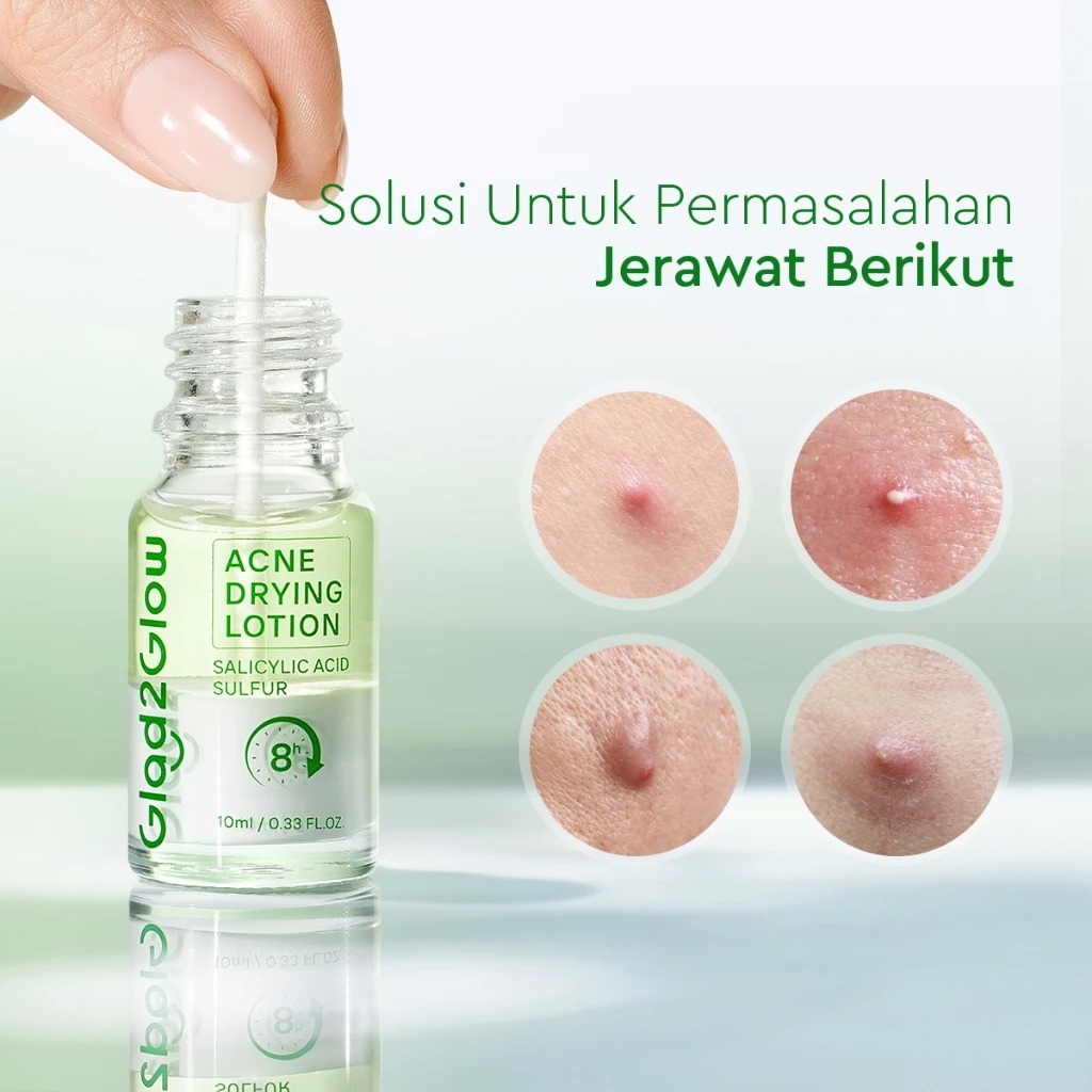 Glad 2 Glow Acne Drying Lotion 10ml