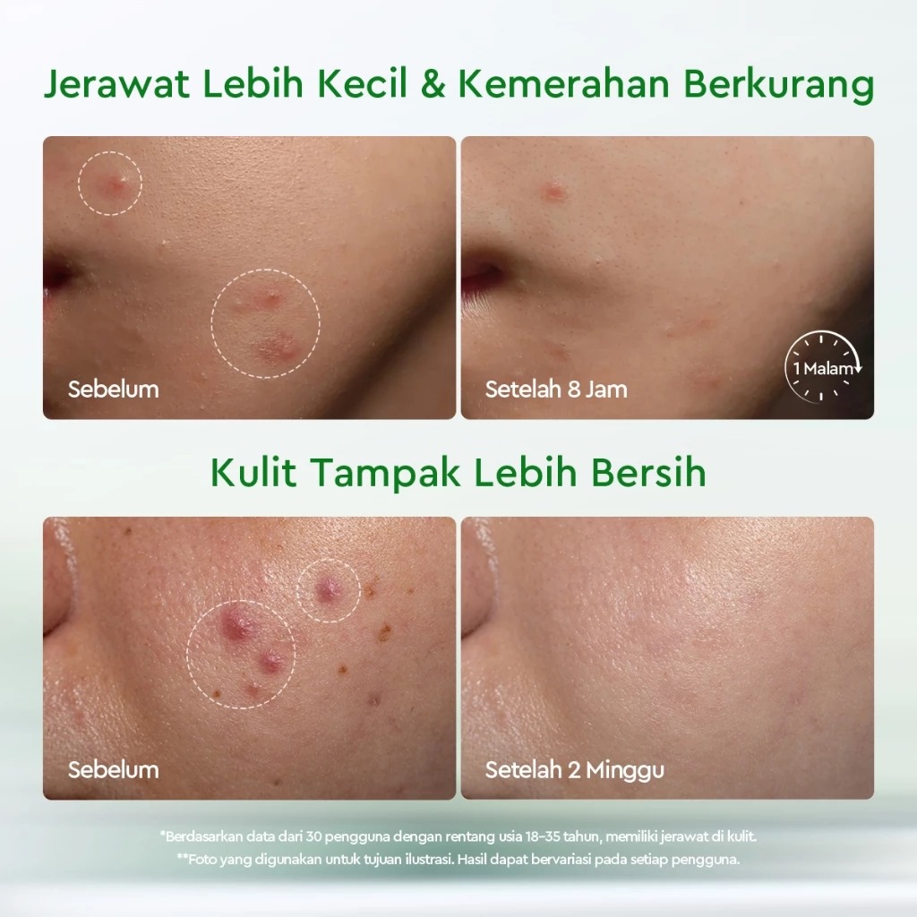 Glad 2 Glow Acne Drying Lotion 10ml