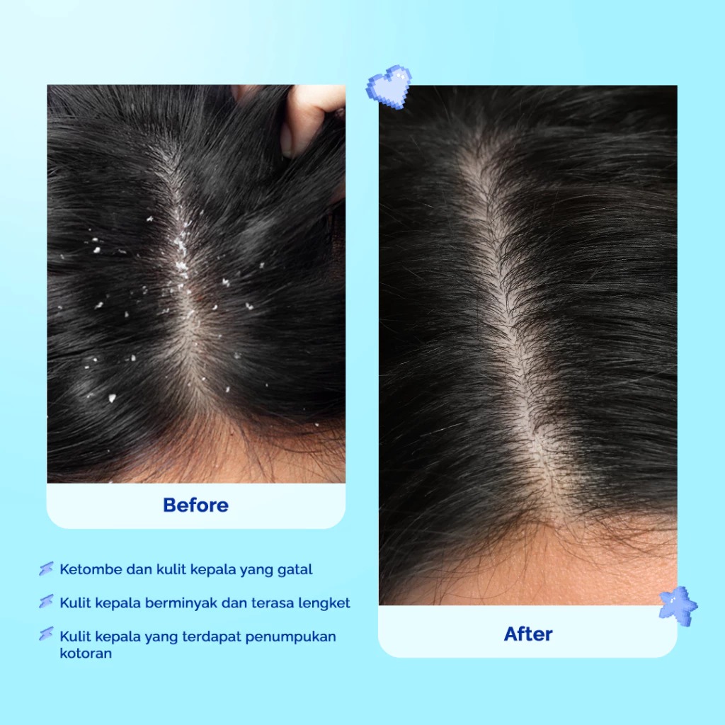 Hair Inc Dandruff Be Gone! Shampoo 320ml (Rambut Anti Ketombe)