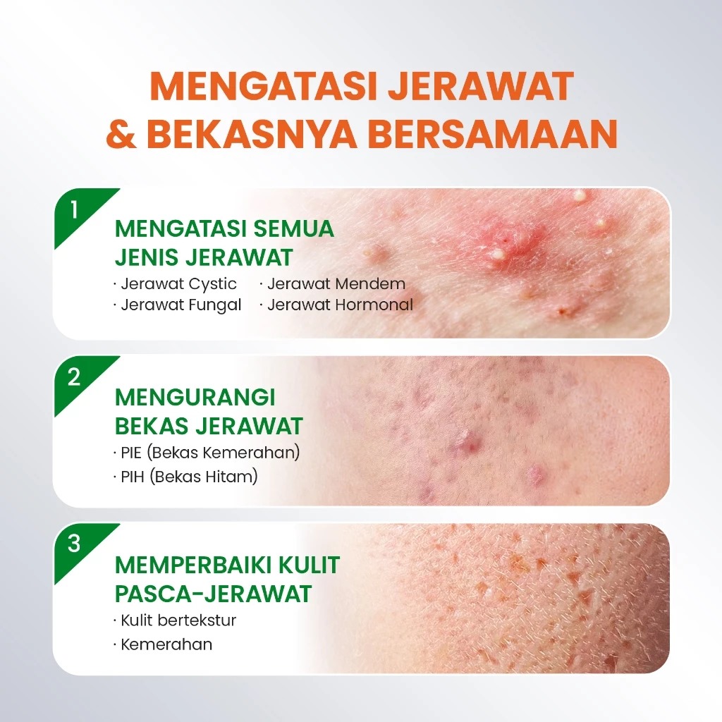 YOU Acneplus Spot Care Pro Serum 15gr