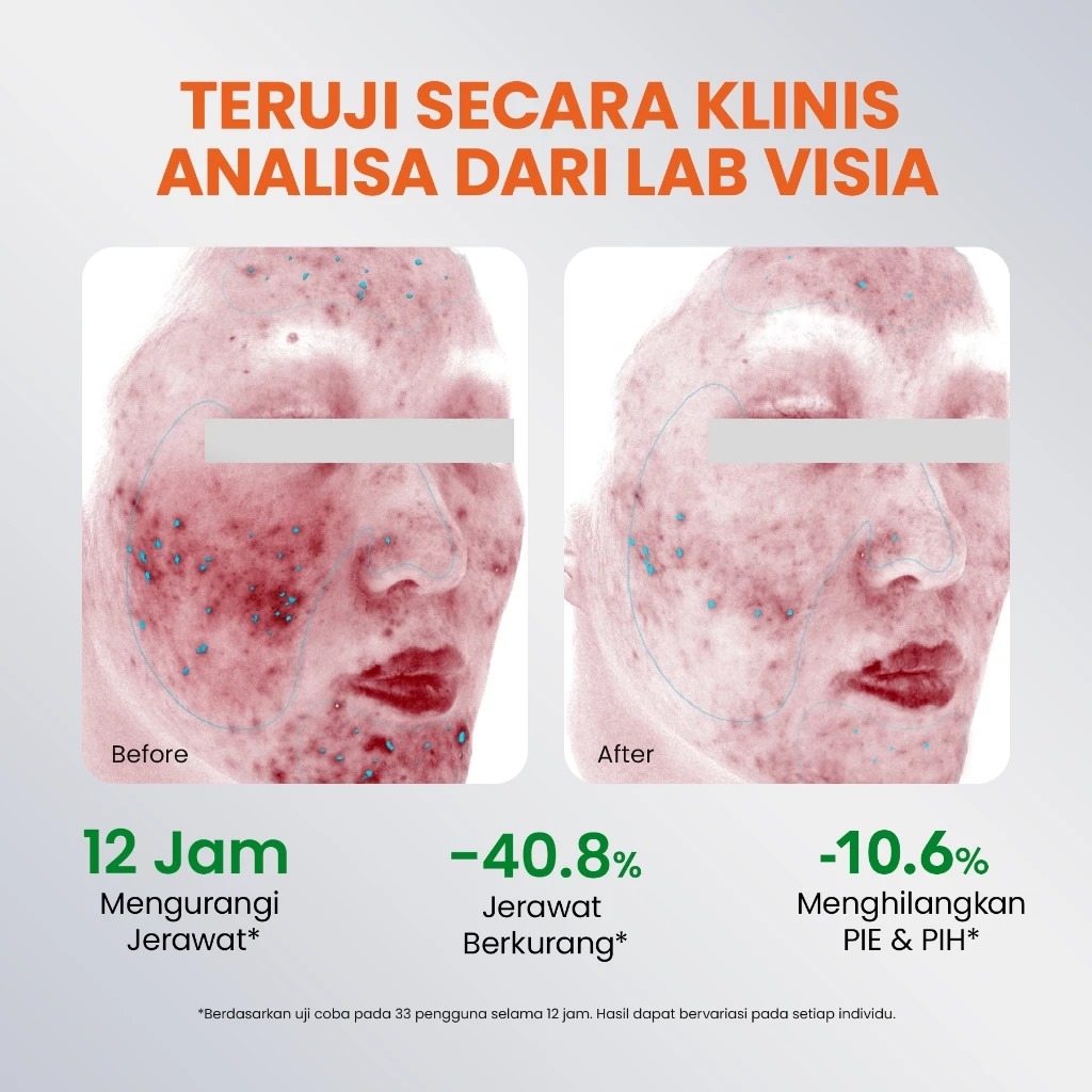 YOU Acneplus Spot Care Pro Serum 15gr